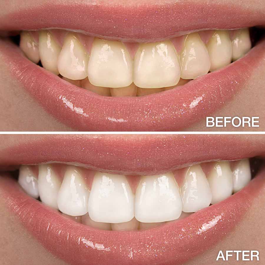 teeth whitening fotor