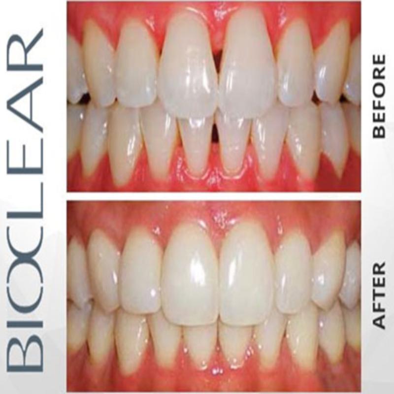 Bioclear